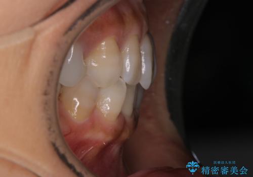 【インビザライン】下前歯だけを治したいの治療前