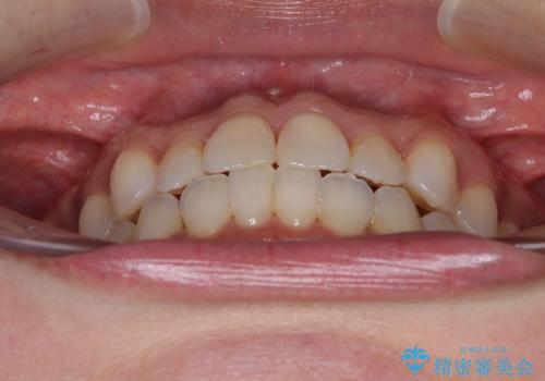 前歯のクロスバイト インビザラインによる矯正治療の治療後