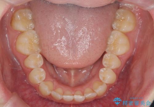 前歯のねじれを治したい マウスピース矯正治療の治療中