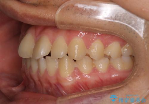 【クリア装置】前歯のがたつきが気になるの治療前