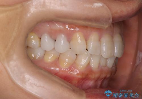 【インビザライン】下前歯だけを治したいの治療前