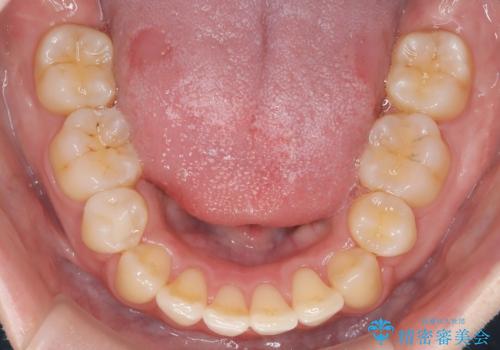 前歯のデコボコを抜歯矯正で改善|アンカースクリューで口元もスッキリの治療後