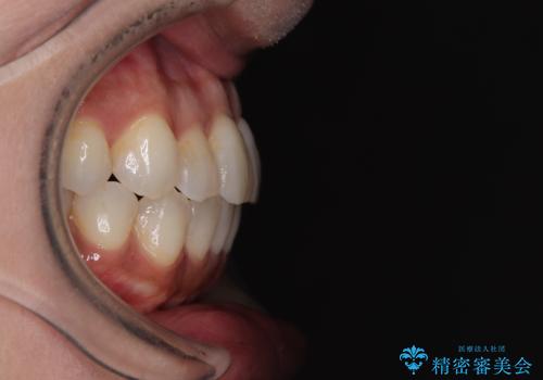 前歯のクロスバイト インビザラインによる矯正治療の治療後