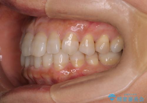 【インビザライン】下前歯だけを治したいの治療前