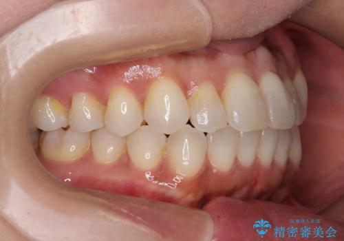 前歯のクロスバイト インビザラインによる矯正治療の治療後