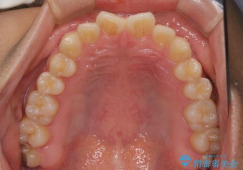 【クリア装置】前歯のがたつきが気になるの治療前