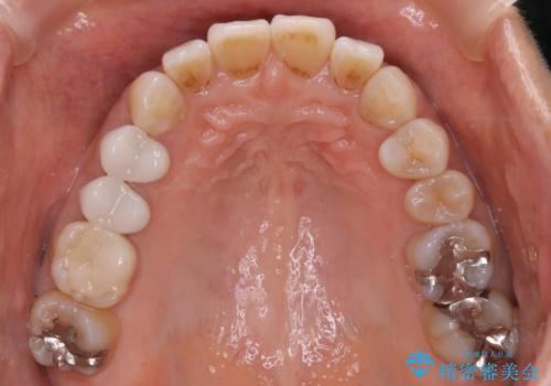 【インビザライン】下前歯だけを治したいの治療前