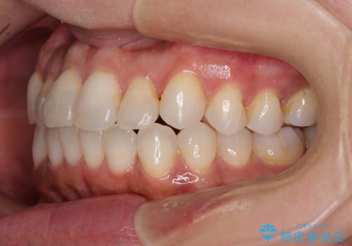 前歯のクロスバイト インビザラインによる矯正治療の治療後