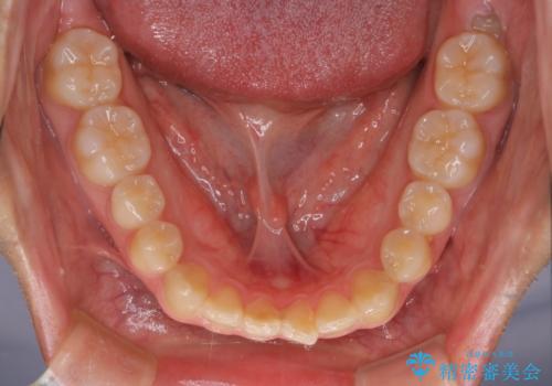 【クリア装置】前歯のがたつきが気になるの治療前