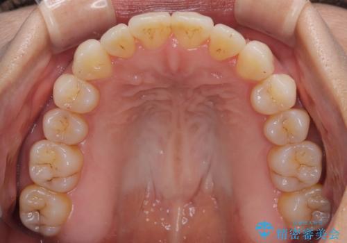 前歯のクロスバイト インビザラインによる矯正治療の治療後