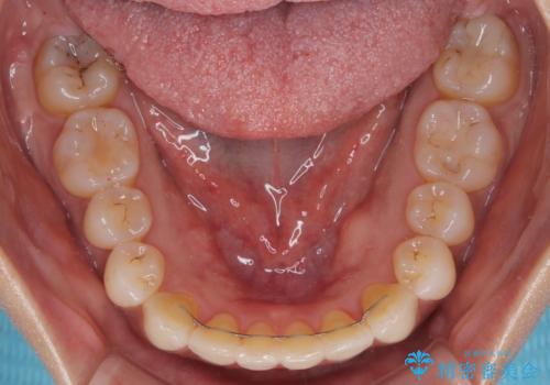 前歯のクロスバイト インビザラインによる矯正治療の治療後