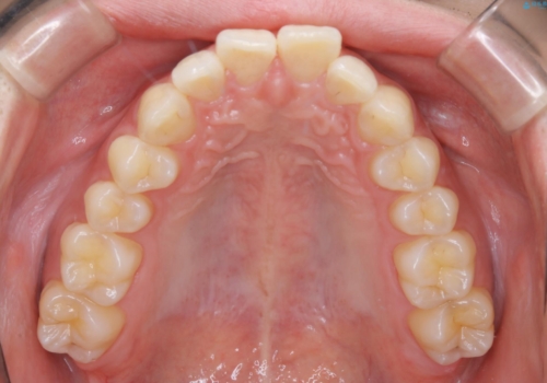 低予算・短期間での歯並び改善:インビザライン治療の治療前