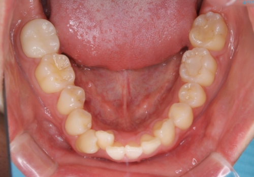 低予算・短期間での歯並び改善:インビザライン治療の治療前