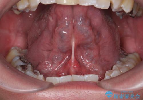 舌小帯が気になる。 舌小帯切除術の治療前
