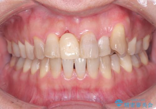 歯周病治療とエアーフローの症例 治療後