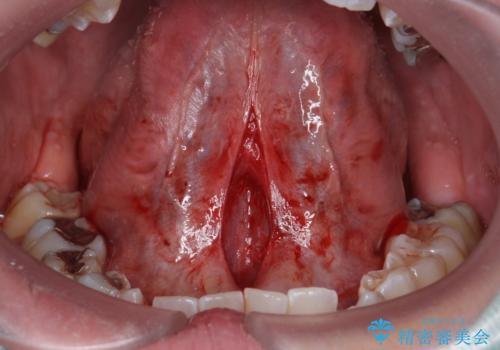 舌小帯が気になる。 舌小帯切除術の治療中