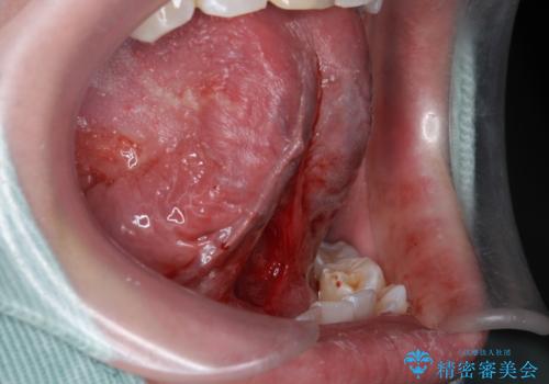 舌小帯が気になる。 舌小帯切除術の治療中