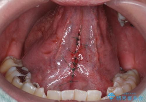 舌小帯が気になる。 舌小帯切除術の治療中