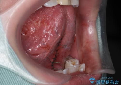 舌小帯が気になる。 舌小帯切除術の治療中