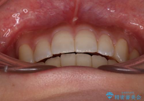 【審美装置】八重歯気になるの治療後