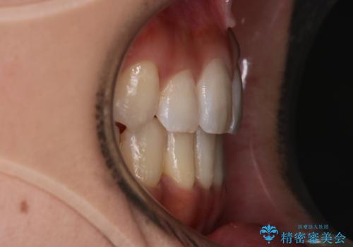 【審美装置】八重歯気になるの治療後