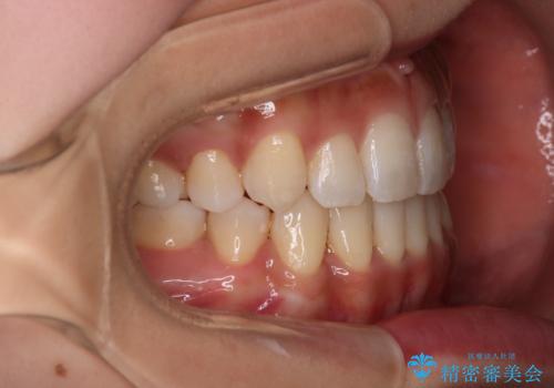 【審美装置】八重歯気になるの治療後