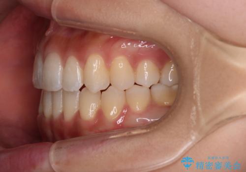 【審美装置】八重歯気になるの治療後