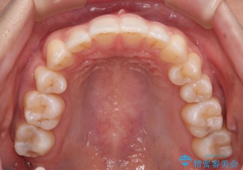 【審美装置】八重歯気になるの治療後