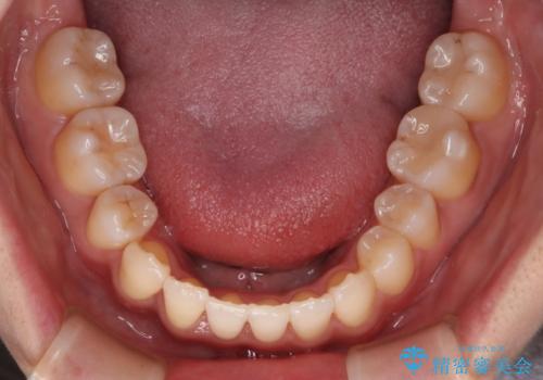 【審美装置】八重歯気になるの治療後