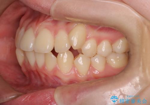インビザラインで八重歯を抜歯矯正|ゴムかけを活用し美しい歯並びへの治療前