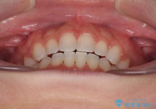 前歯のデコボコとクロスバイト ワイヤー装置での抜歯矯正の治療後