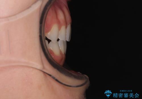 前歯のデコボコとクロスバイト ワイヤー装置での抜歯矯正の治療後