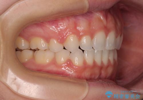 前歯のデコボコとクロスバイト ワイヤー装置での抜歯矯正の治療後