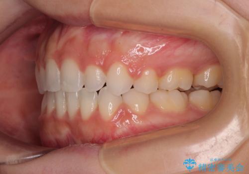 前歯のデコボコとクロスバイト ワイヤー装置での抜歯矯正の治療後