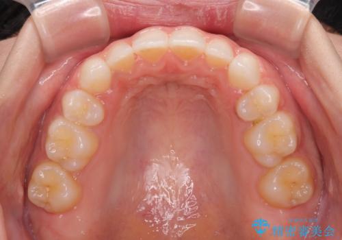 前歯のデコボコとクロスバイト ワイヤー装置での抜歯矯正の治療後