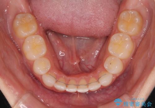 前歯のデコボコとクロスバイト ワイヤー装置での抜歯矯正の治療後