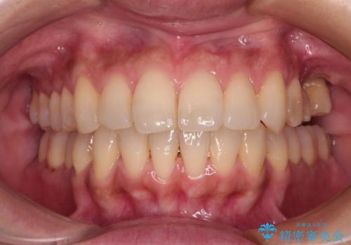 インビザラインによる矯正治療と奥歯のインプラント治療の治療中