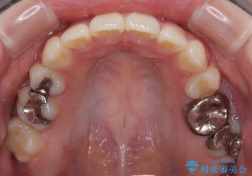 口元の突出感を改善したい。リンガルアーチを併用した抜歯矯正の治療後