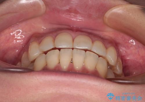 インビザラインによる矯正治療と奥歯のインプラント治療の治療中