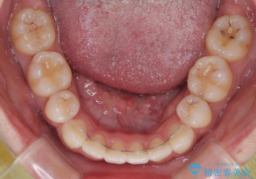 口元の突出感を改善したい。リンガルアーチを併用した抜歯矯正の治療後