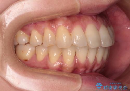 インビザラインによる矯正治療と奥歯のインプラント治療の治療中