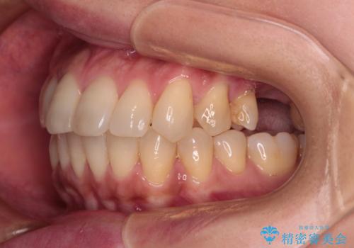 インビザラインによる矯正治療と奥歯のインプラント治療の治療中