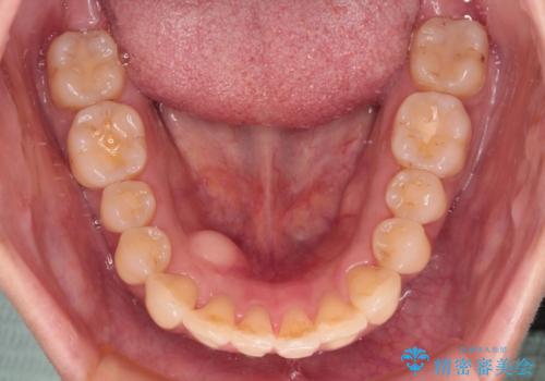 インビザラインによる矯正治療と奥歯のインプラント治療の治療中