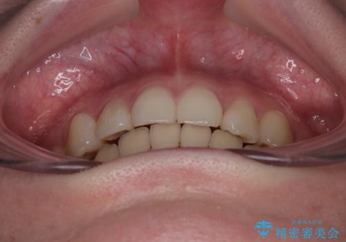 上下の八重歯とクロスバイト ワイヤー装置での抜歯矯正の治療後
