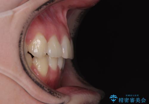 上下の八重歯とクロスバイト ワイヤー装置での抜歯矯正の治療後