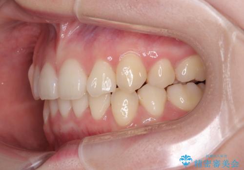 上下の八重歯とクロスバイト ワイヤー装置での抜歯矯正の治療後