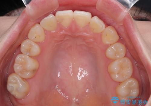 上下の八重歯とクロスバイト ワイヤー装置での抜歯矯正の治療後