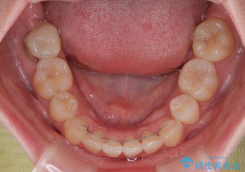 上下の八重歯とクロスバイト ワイヤー装置での抜歯矯正の治療後