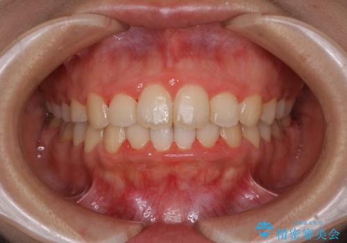 インビザラインが使えなかった:ワイヤーで仕上げ治療の治療後