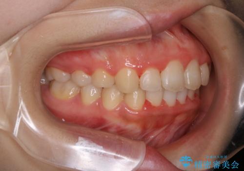 インビザラインが使えなかった:ワイヤーで仕上げ治療の治療後